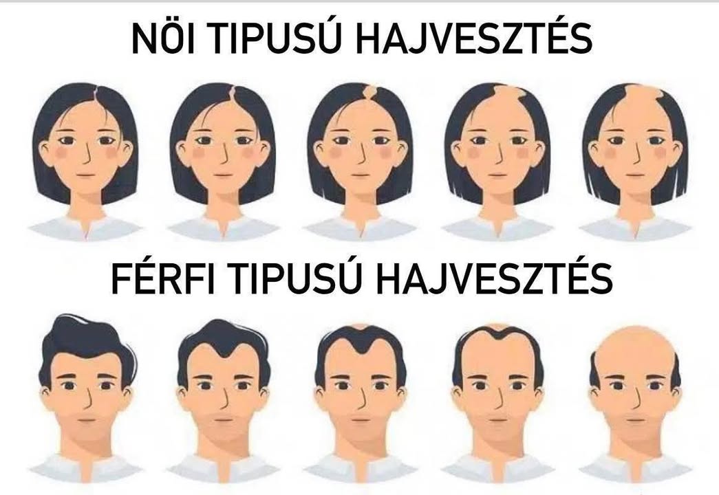 A női típusú és férfi típusú hajvesztés stádiumai – hajhullás típusok
